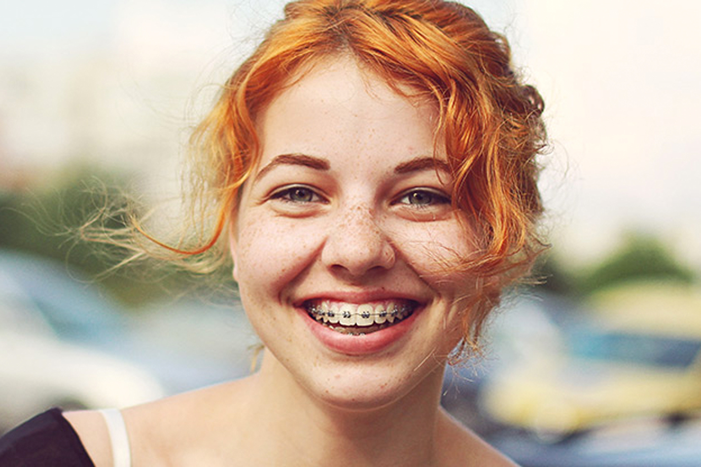 Fixed-braces-Right-Image