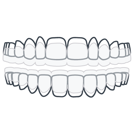 Invisalign 2x